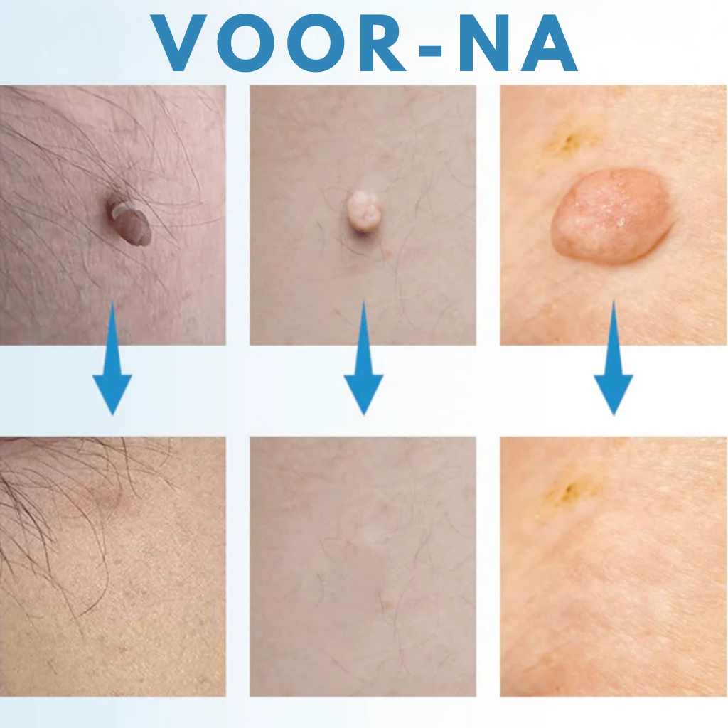 Skinova - Huidverwijderings Kit