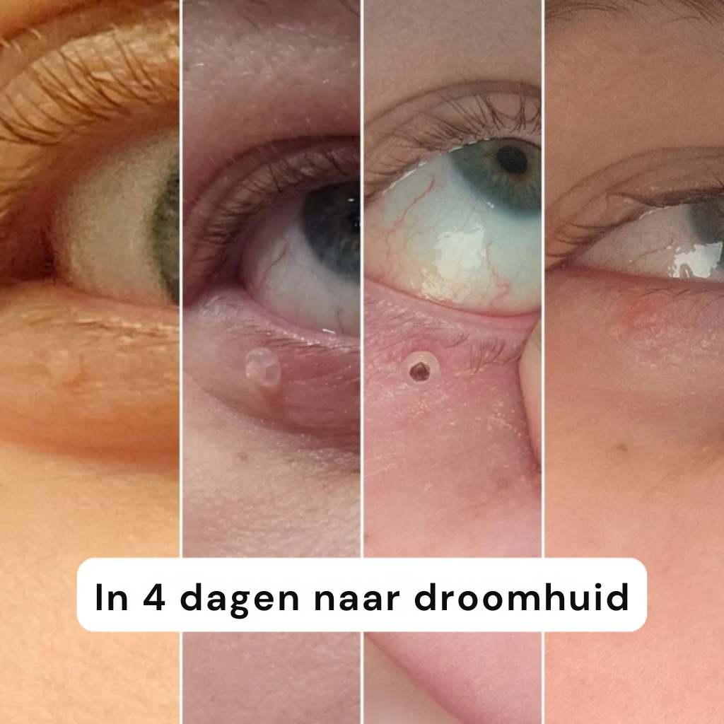 Skinova - Huidverwijderings Kit