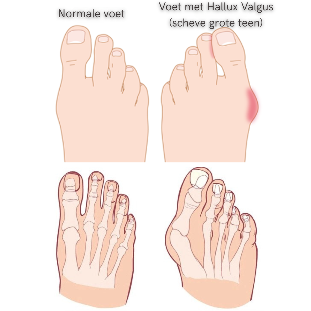 Illustratie van een normale voet en een voet met een scheve grote teen