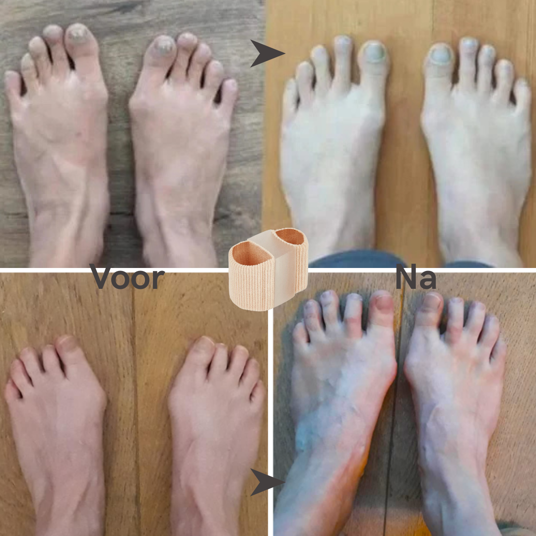 Foto's van voeten voor en na het dragen van de TeenCorrector